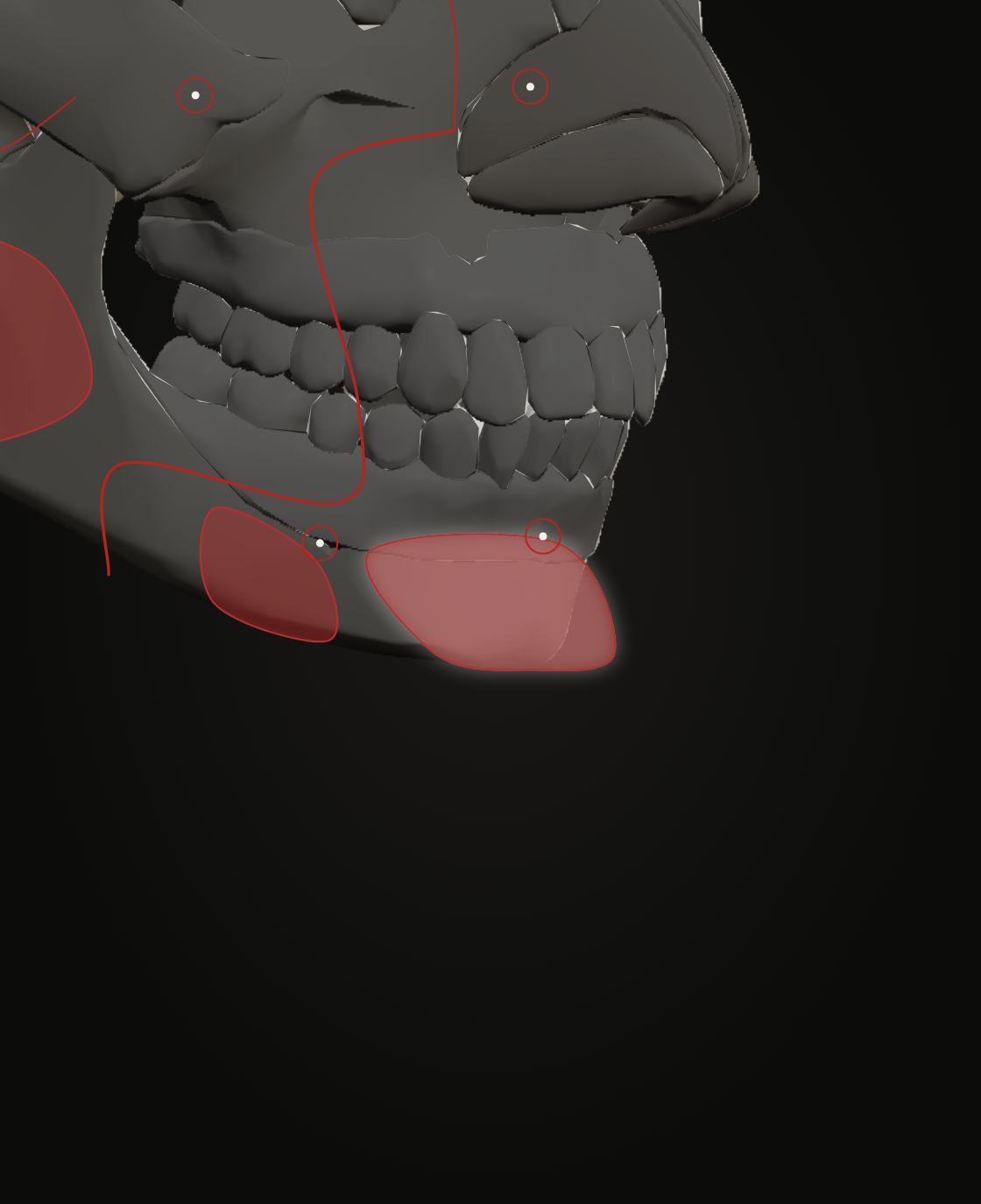 Install anchors on the mandible of the reference skull, three-quarter view, with the mental foramen marked