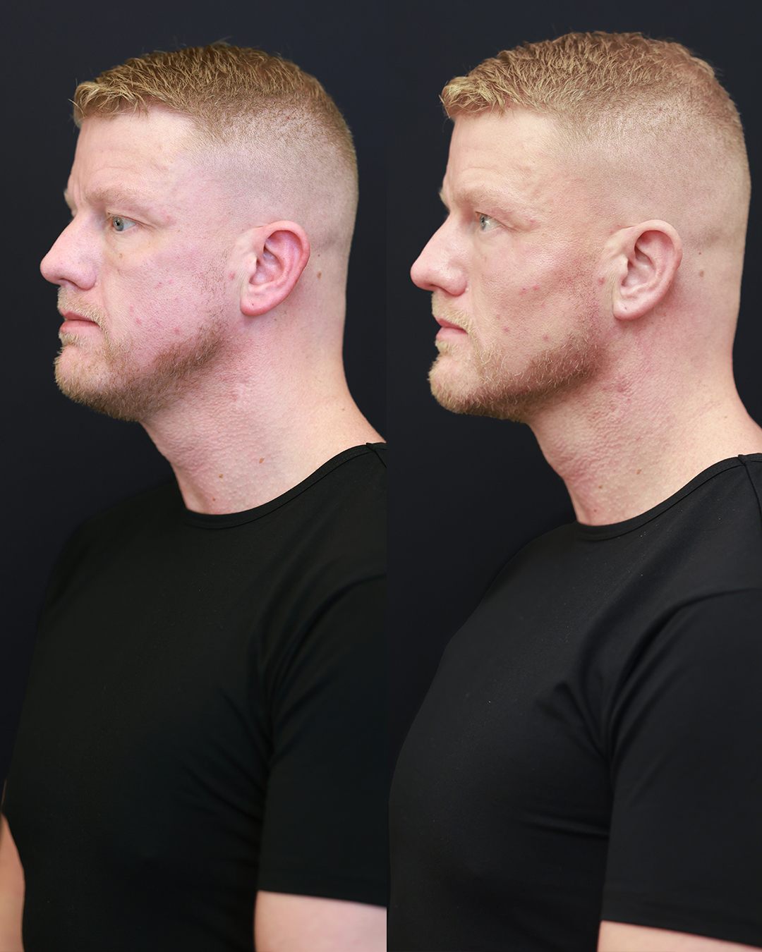 Lower face and jaw definition, unretouched