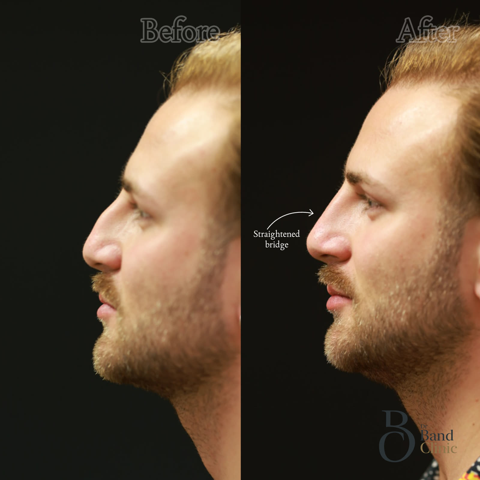 Non-surgical rhinoplasty, unretouched
